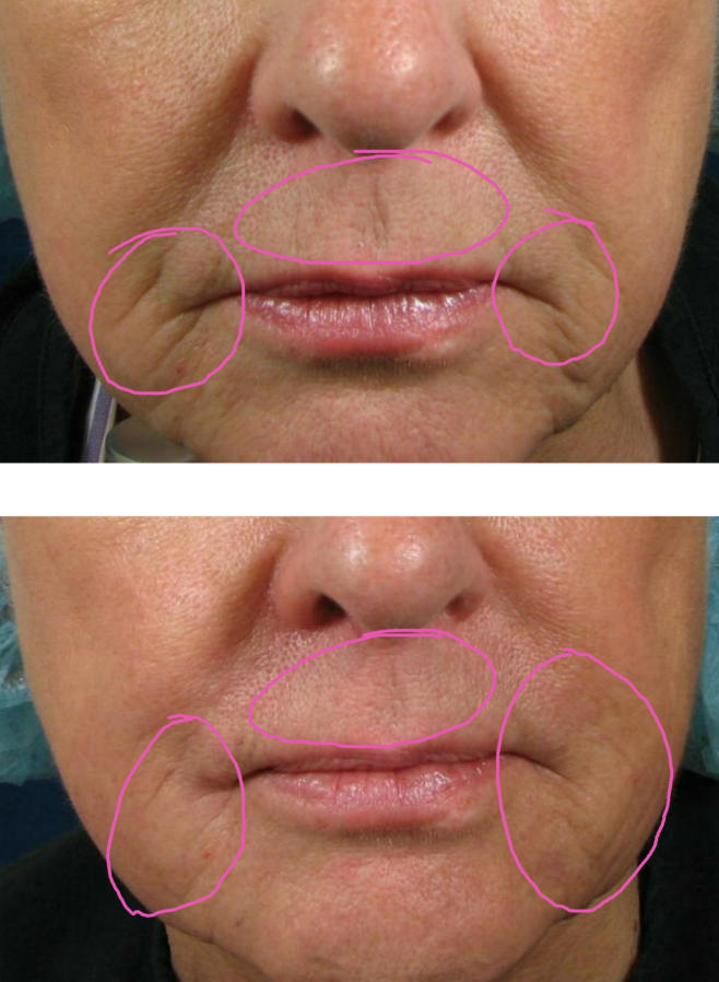 M Beauty by Dr. Tess - Juvederm and Voluma